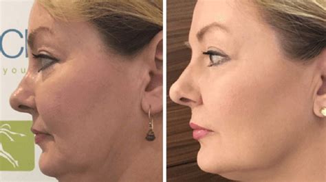 HIFU: Non-Surgical Body Contouring and Facelift - Achieve Your Desired Look