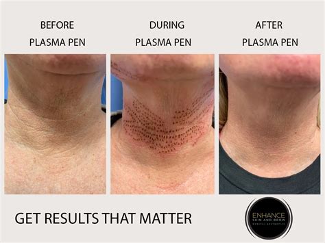 Plasma Pen Treatment After Care Warehouse Sale | vrre.univ-mosta.dz