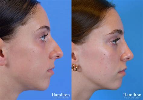 Rhinoplasty Before & After Gallery