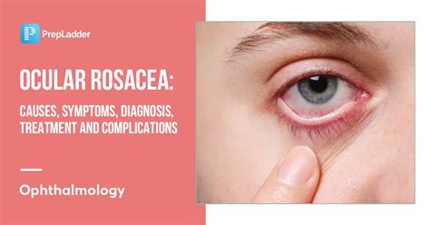 Ocular Rosacea: Causes, Symptoms, Diagnosis, Treatment and Complications