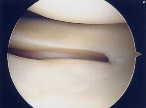 Knee Arthroscopy — Amir Qureshi Orthopaedic Surgeon | Knee Surgeon Southampton