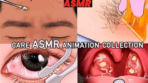 ASMR | mouth treatment || Salivary Gland Stone' Removal Animation 3D animation video - YouTube