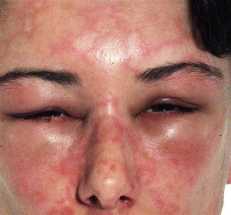 Angioedema causes, symptoms, diagnosis and angioedema treatment