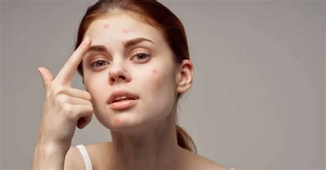 Is Egg And Cinnamon Good For Acne? - Talk Leisure