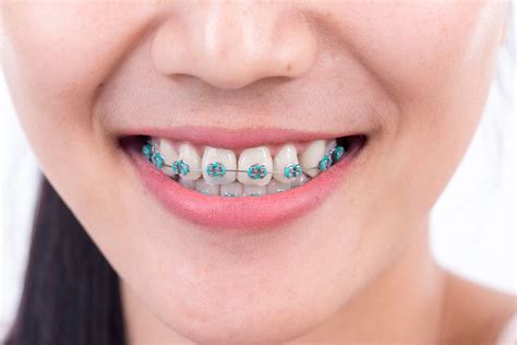 How To Put Rubber Bands On Braces For Overbite - Is it really that bad ...