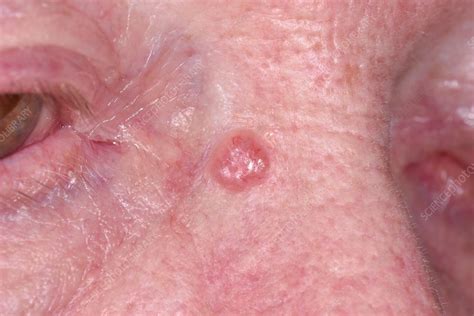 What Is Basal Cell Carcinoma Skin Cancer | Images and Photos finder