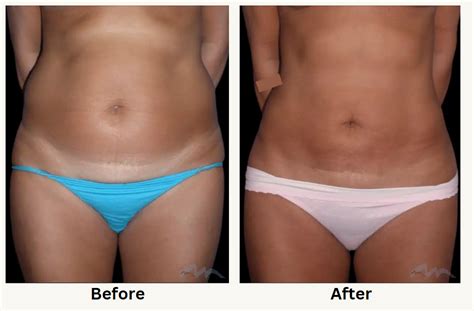 Liposuction Surgery in Miami, FL | Miami Plastic Surgery