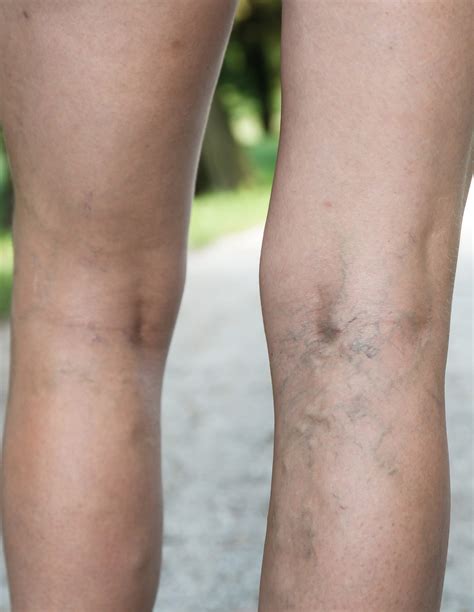 Varicose Veins | Vascular Surgeons Melbourne | Melbourne Vascular Associates