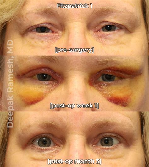 Recovery from Eyelid Surgery New Jersey | Dr. Deepak Ramesh