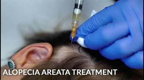 PRP, Stem Cells & Steroid Injections for Alopecia Areata Female Hair Loss Treatment | Dr. Jason ...