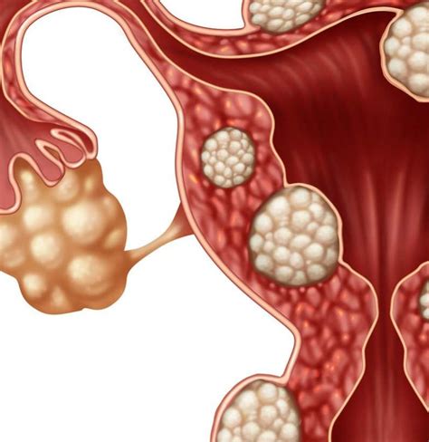 Fibromas: Causas, síntomas y tratamiento