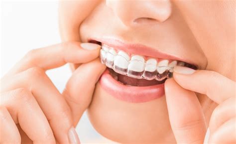 Teeth Whitening Strips & Tray - Which Are Better? | White Plains Dental®