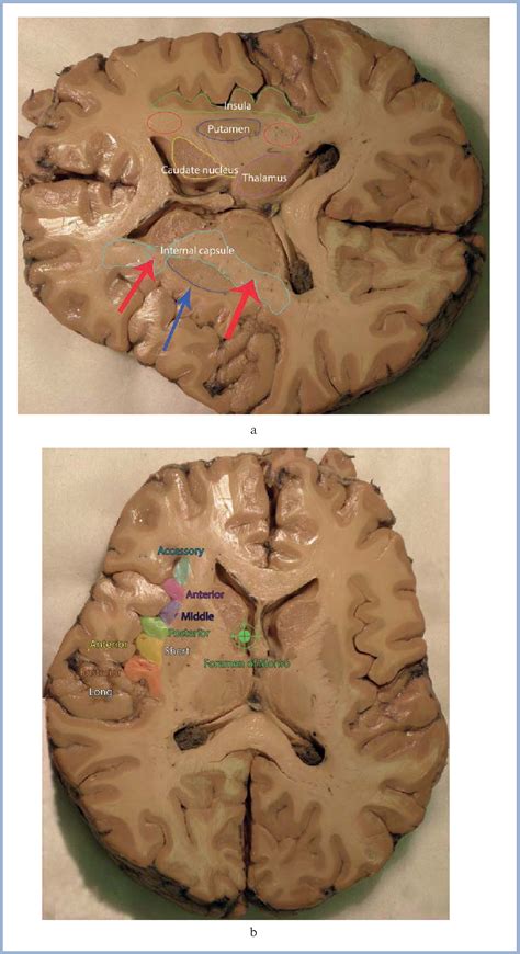 Insula Brain Anatomy