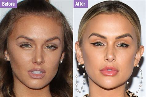 Vanderpump Rules’ Lala Kent loves her ‘new face’ after plastic surgery ...