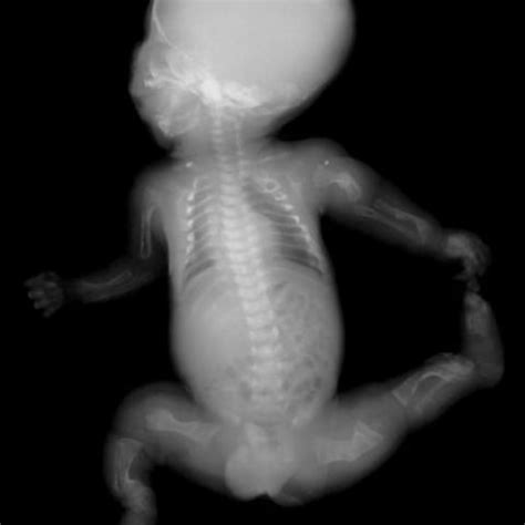 Prenatal sonographic diagnosis of osteogenesis imperfecta | Eurorad