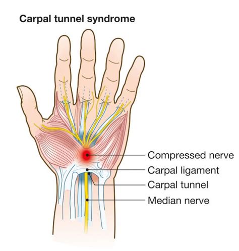 What causes carpal tunnel syndrome? | Catching Health with Diane Atwood