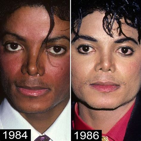 Michael Jackson Vitiligo Lupus