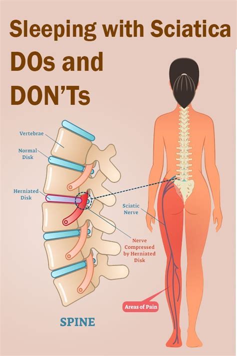 Sleeping with Sciatica - DOs and DON'Ts - The Health Science Journal