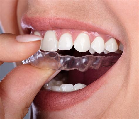 Dentist Shares Invisalign Clear Aligners Benefits Calgary