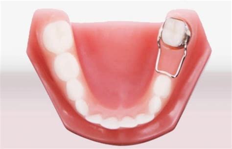 What Is A Space Maintainer in Orthodontics? - ArchWired