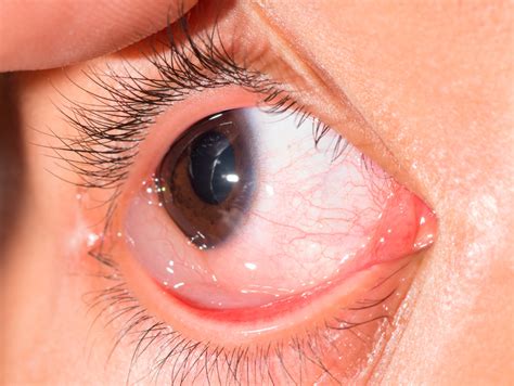 ¿Qué es la quemosis conjuntival? Síntomas y Tratamiento