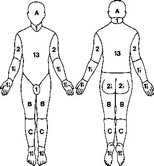 Chart For Estimating Severity Of Burn Wound - Care of Wounds | Burn ...