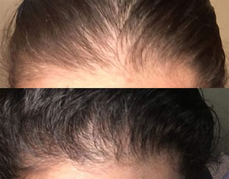 This Biotin Shampoo's Before And After Photos Will Have You Believing In Miracles