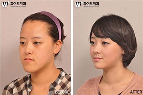 31 Crazy Before And After Photos Of Korean Plastic Surgery | Korean ...