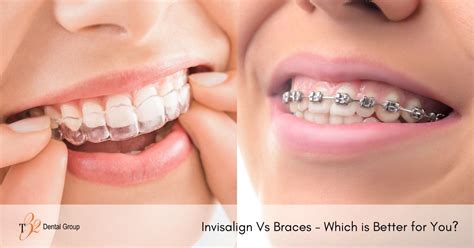 Invisalign vs Braces – Which is Better for You? | T32 Dental Group