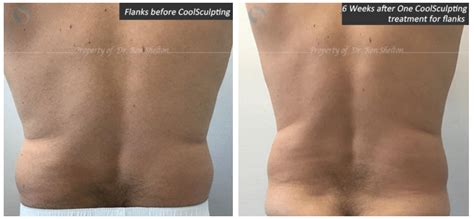 CoolSculpting Fat Reduction NYC | Coolsculpting flanks - Ron Shelton M.D