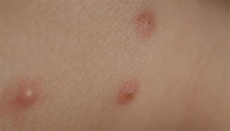 Identifying Common Insect Bites and Stings | Sentinel Blog