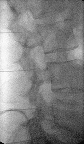 Facet Injections and Radiofrequency Denervation | Radiology Key