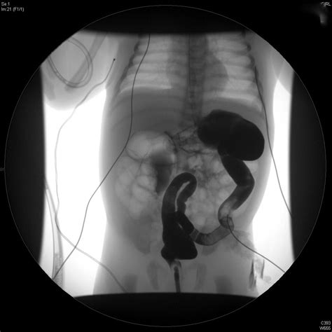 Pediatric Surgery Zone: Is this neonatal small left colon syndrome ...