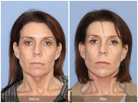 Neck Lift Before & After Photos Patient 75 | Dr Kevin Sadati