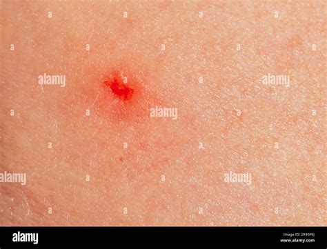 Wound after the removal of a wood tick Stock Photo - Alamy