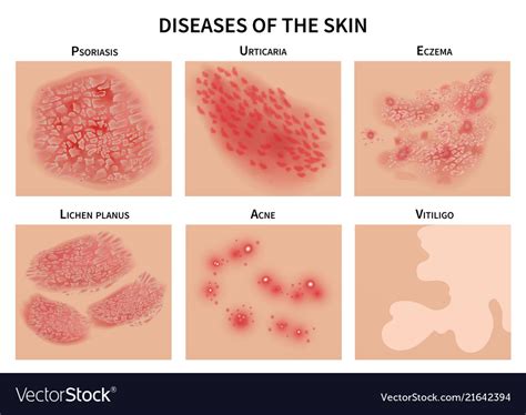 Skin diseases derma infection eczema Royalty Free Vector