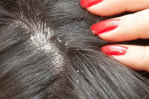 Lice vs. Dandruff - A Complete Guide - Bullock's Buzz