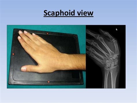 Scaphoid Fractures – Core EM
