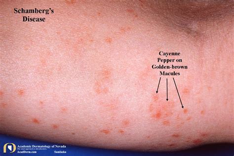 Schamberg's Disease: A Pigmentary Purpuric Eruption... - Academic ...