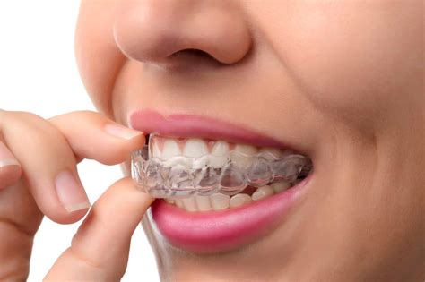 Tips For Living With Invisalign Clear Aligners | Bailey Orthodontics