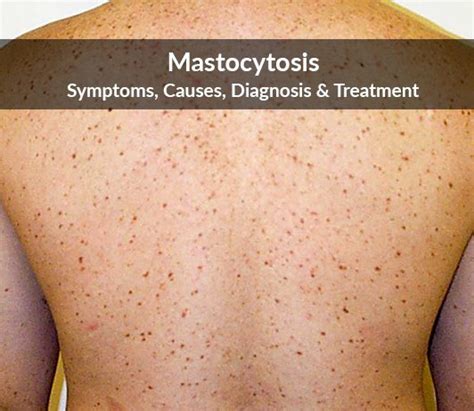 What is mastocytosis? - MEDICINE FOR WORLD