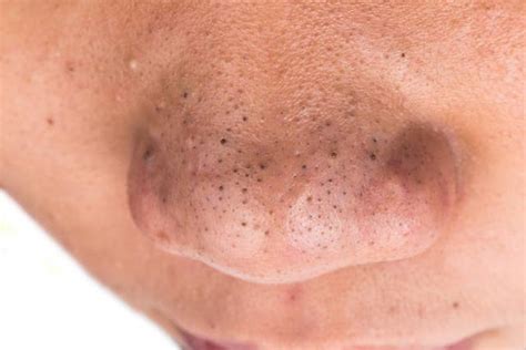 Blackheads vs. Sebaceous Filaments: What’s The Difference? - Dollhouse Beauty