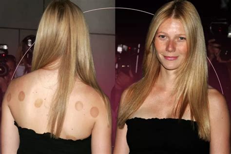 Cupping Marks- What it reveals about your health