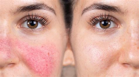 3 ways to treat rosacea in beauty salons