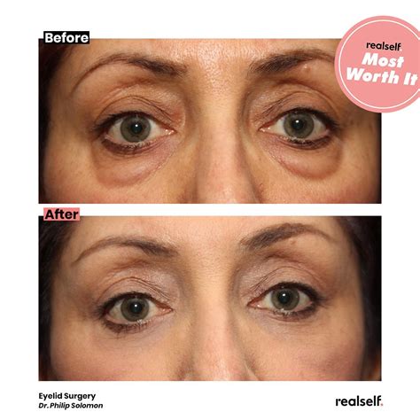 Droppy eyelid surgery - hrommystery