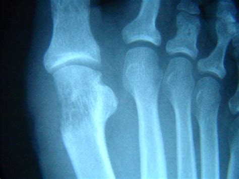 Tibial sesamoid fracture | The Foot and Ankle Online Journal