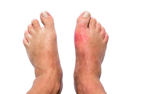 Gout and diet advice | Diabetes Forum • The Global Diabetes Community