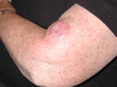 Skin Cancer Lump On Arm