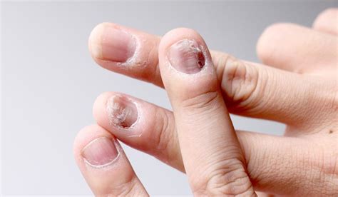 Nail Diseases: Types, Symptoms, Diagnosis, Medical Treatment