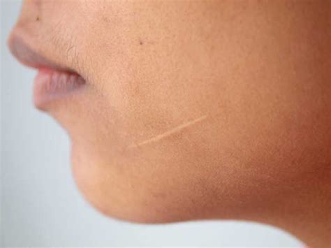 Scar Treatment That Works: 17 Ways to Reduce (and Prevent) Unsightly ...